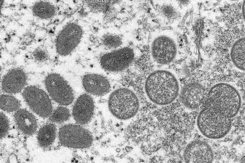 quebecs-public-health-authorities-investigating-a-number-of-suspected-cases-of-monkey-pox